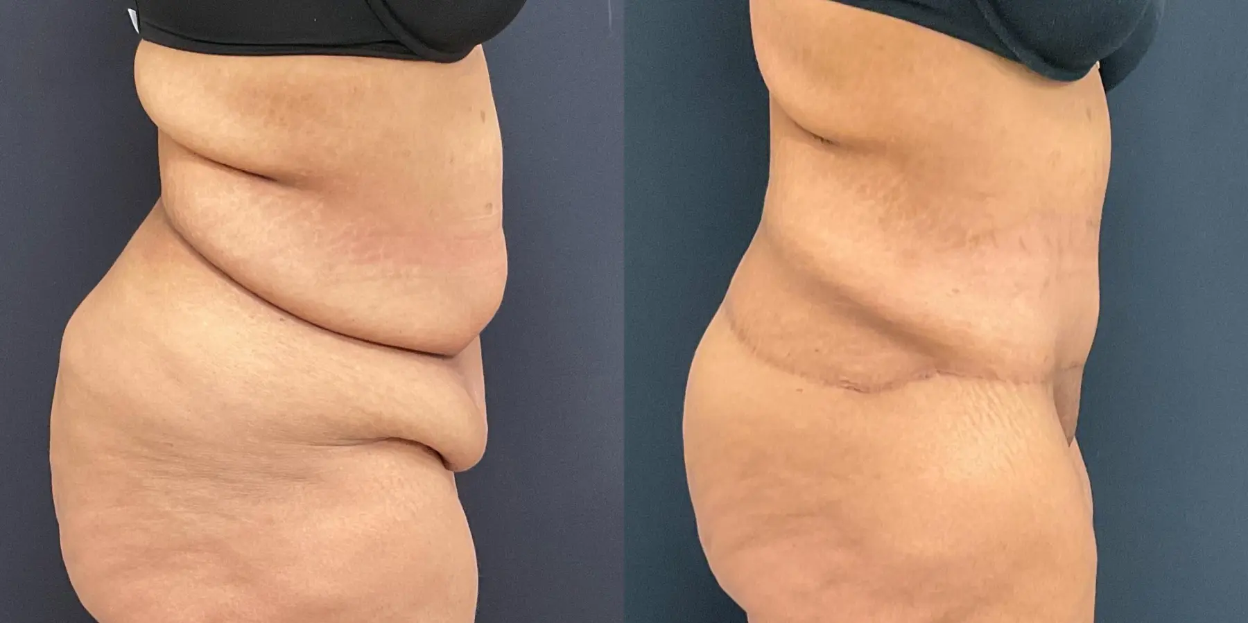 Tummy Tuck: Patient 16 - Before and After 5