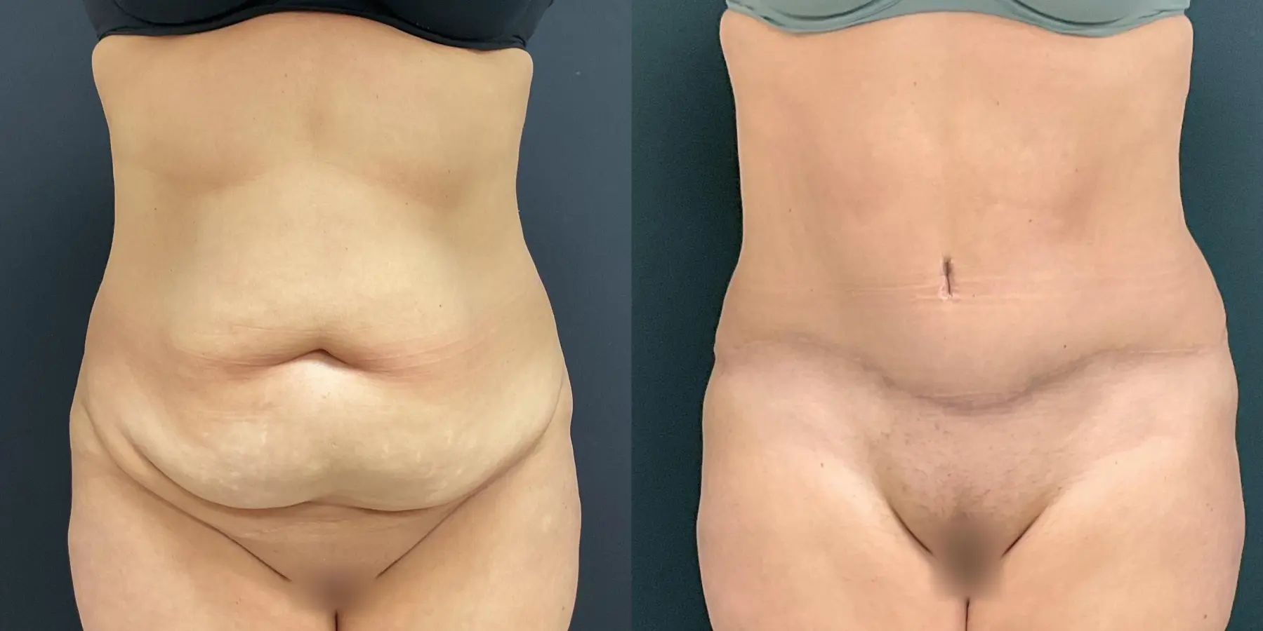 Tummy Tuck: Patient 27 - Before and After 1
