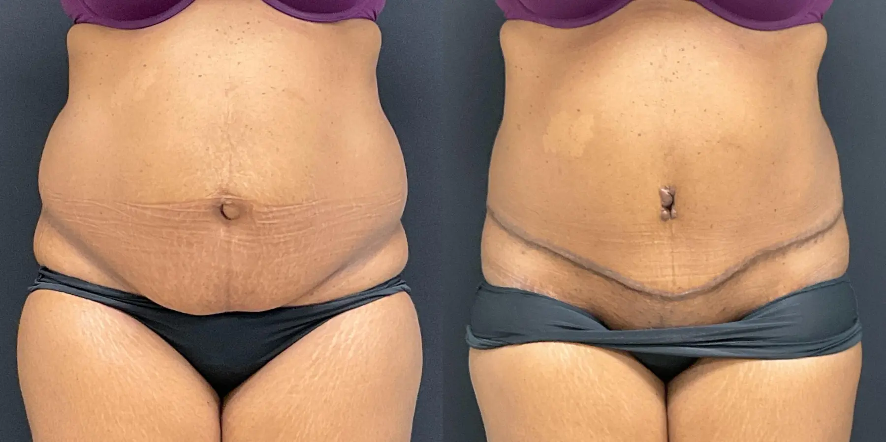 Tummy Tuck: Patient 20 - Before and After 1