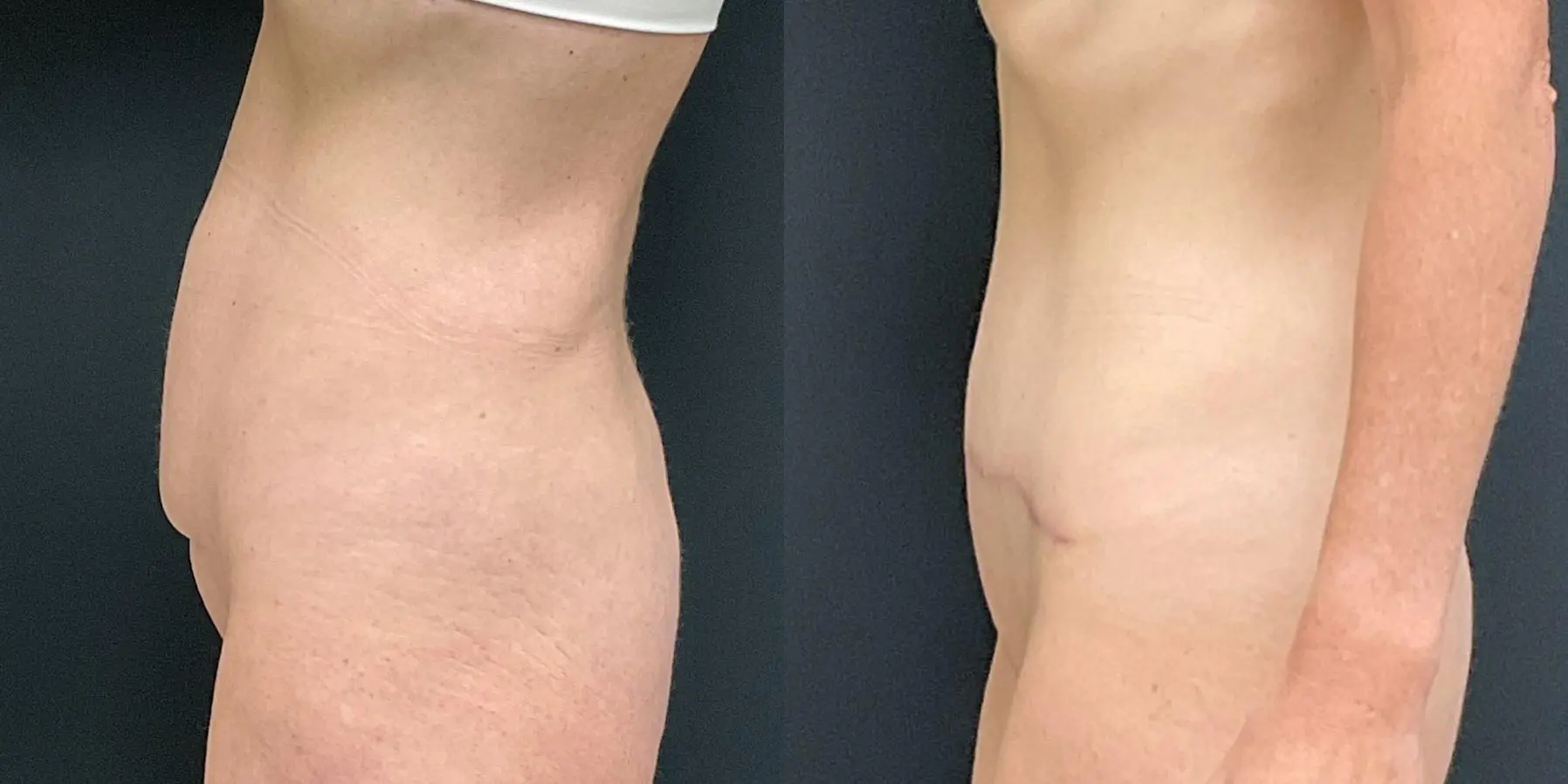 Tummy Tuck: Patient 28 - Before and After 4