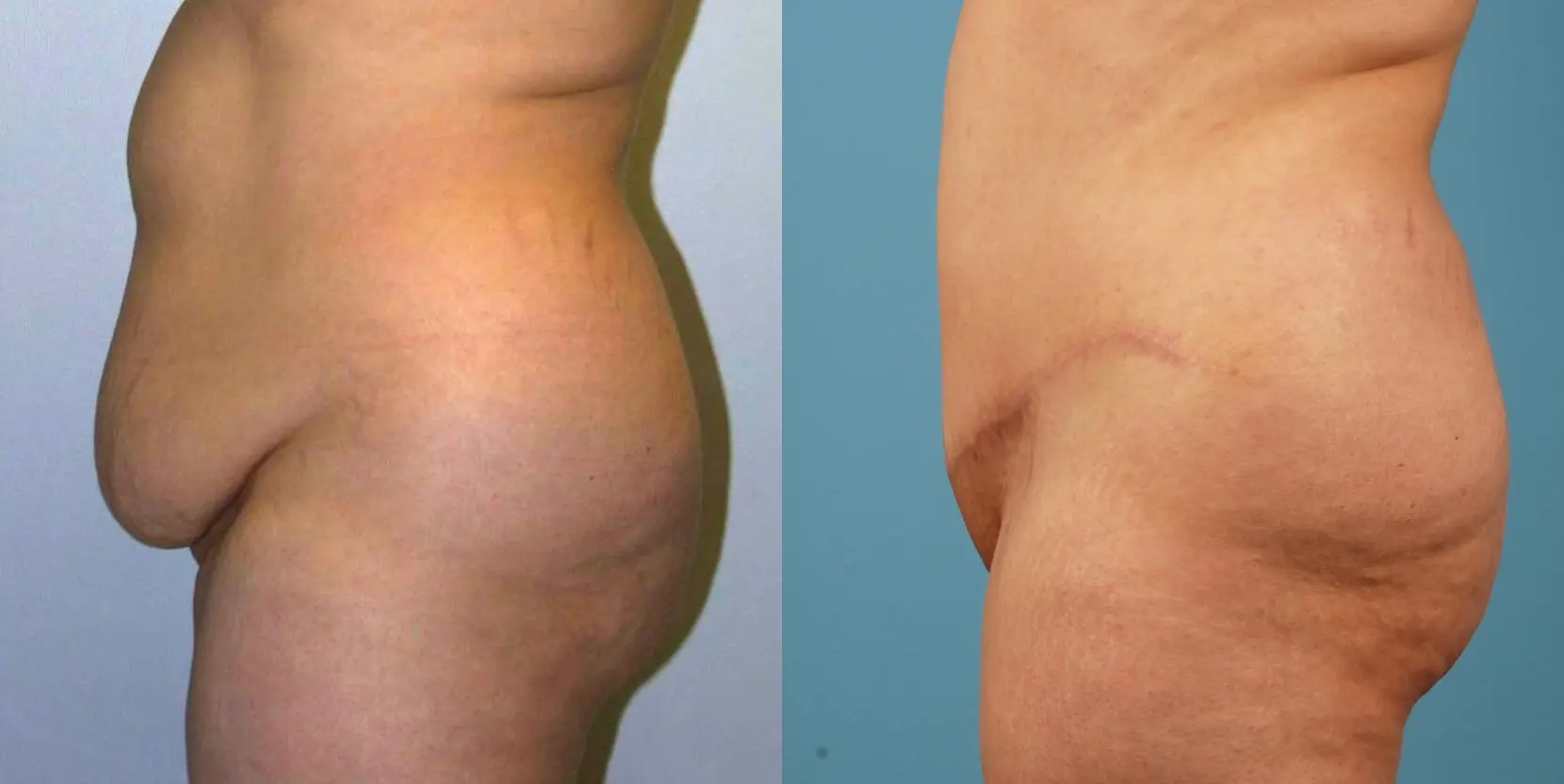 Tummy Tuck: Patient 13 - Before and After 3
