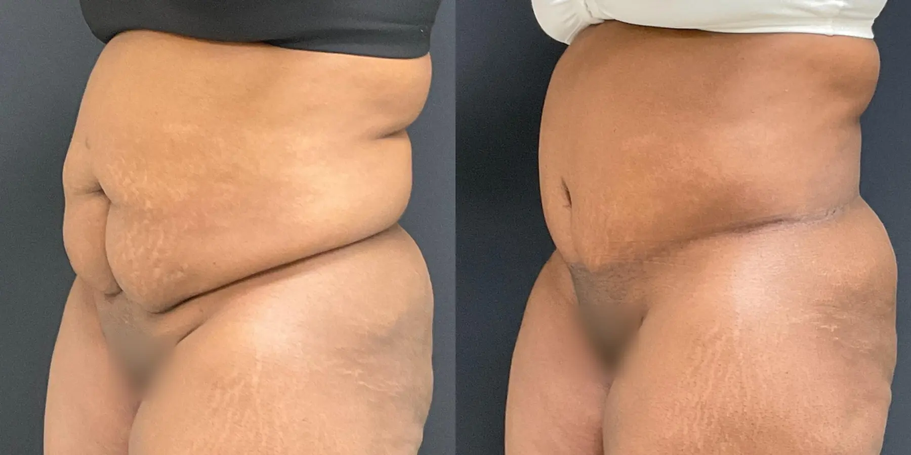 Tummy Tuck: Patient 24 - Before and After 2