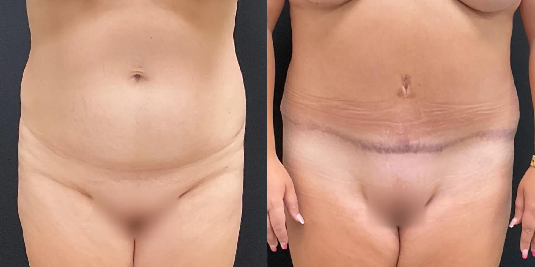Tummy Tuck: Patient 22 - Before and After 1