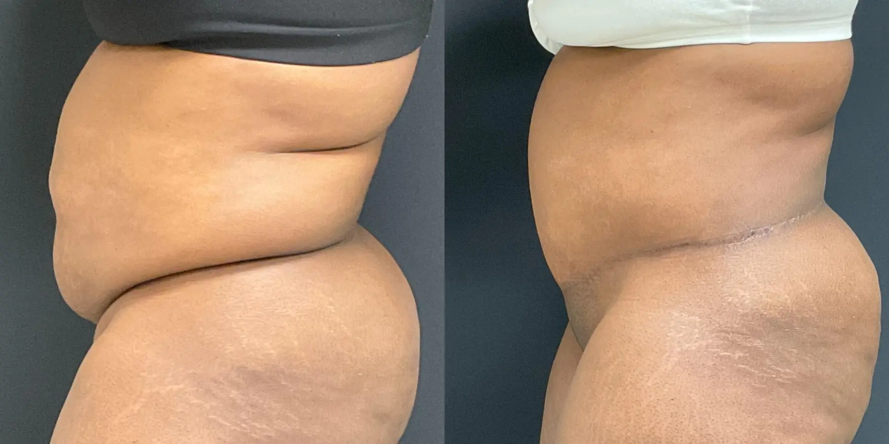 Tummy Tuck: Patient 24 - Before and After 4