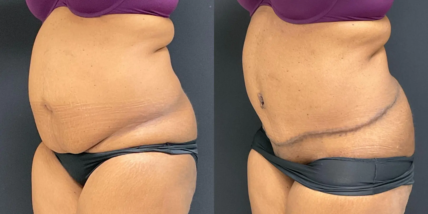 Tummy Tuck: Patient 20 - Before and After 2