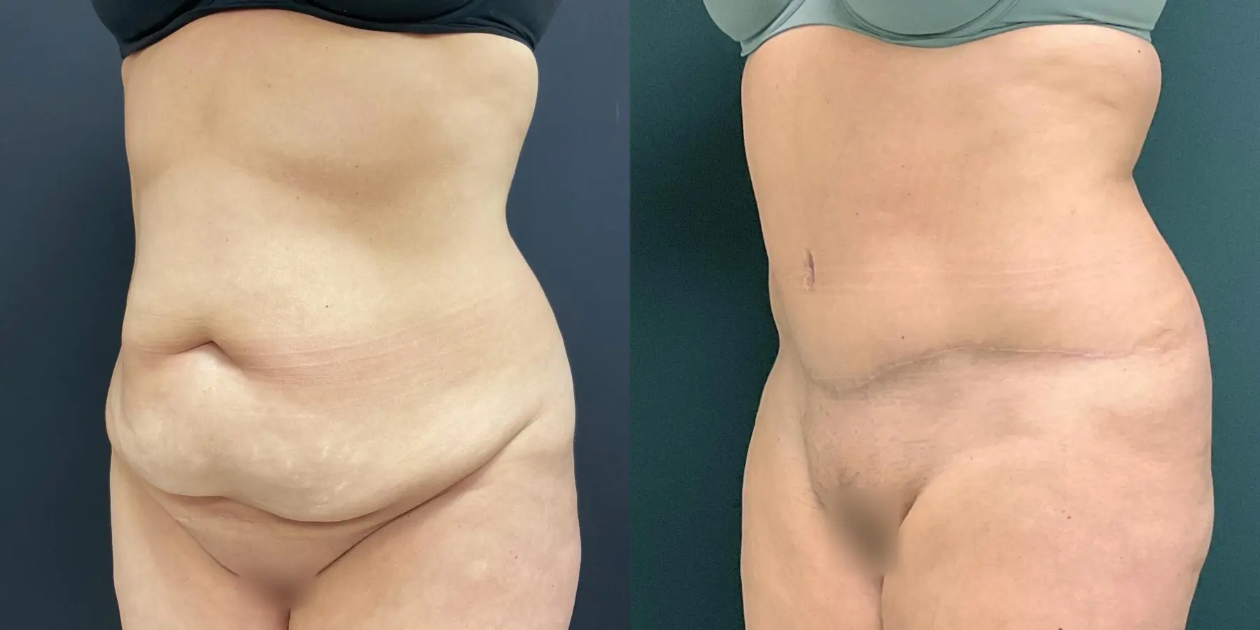 Tummy Tuck: Patient 27 - Before and After 2
