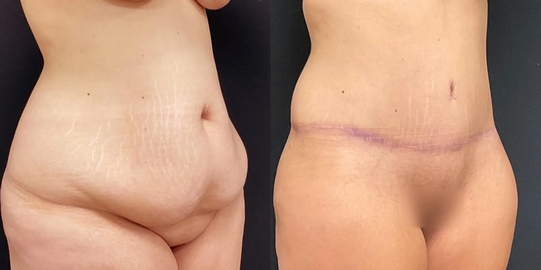 Tummy Tuck: Patient 17 - Before and After 3