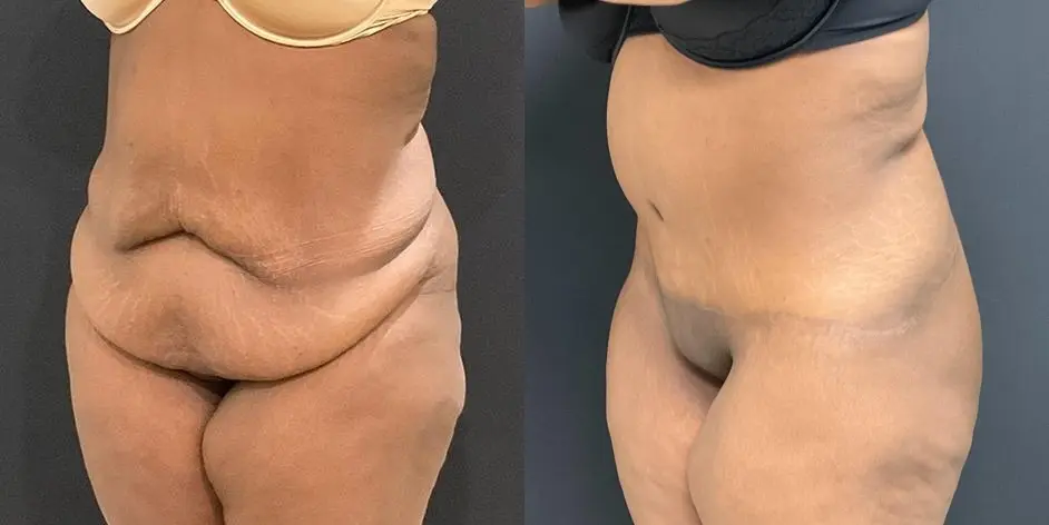 Tummy Tuck: Patient 18 - Before and After 3