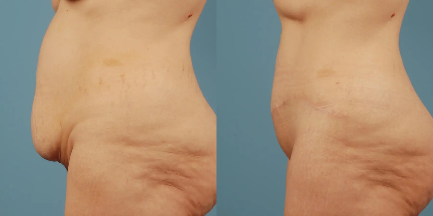 Tummy Tuck: Patient 26 - Before and After 6