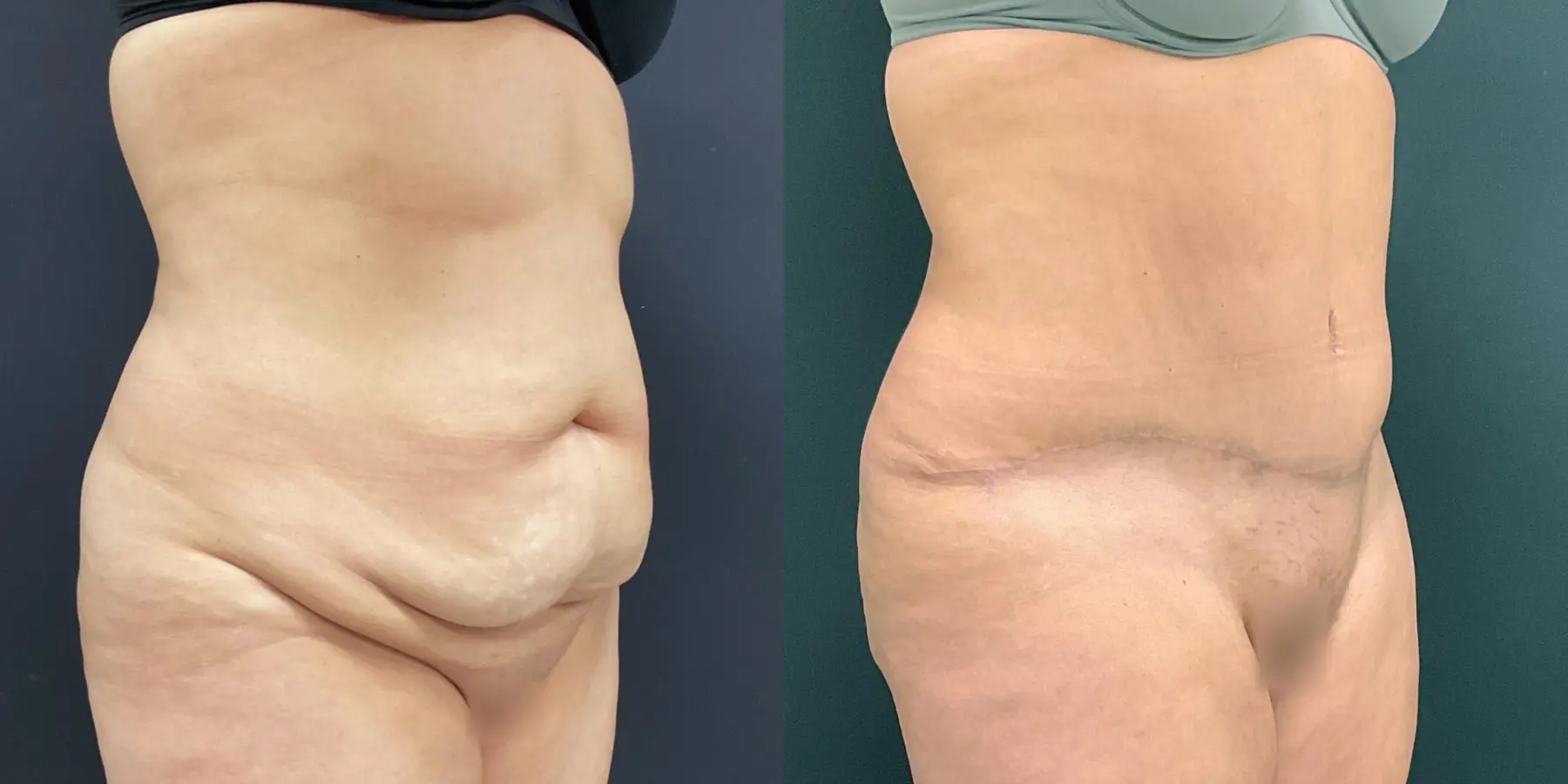 Tummy Tuck: Patient 27 - Before and After 3