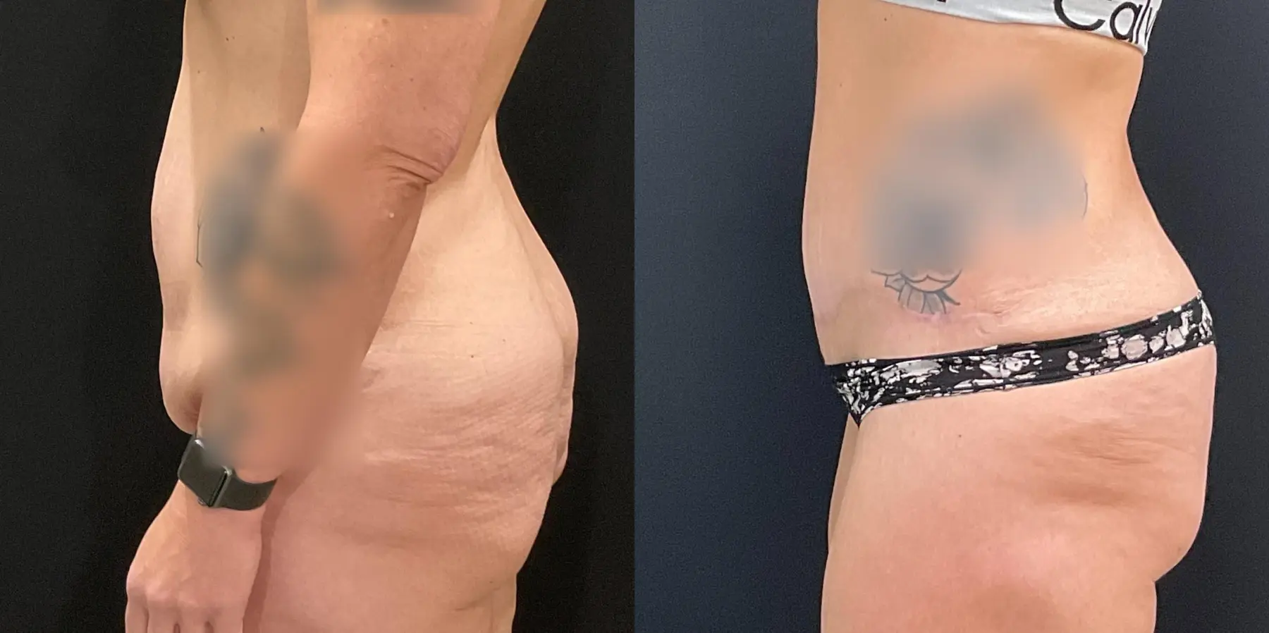 Tummy Tuck: Patient 21 - Before and After 4