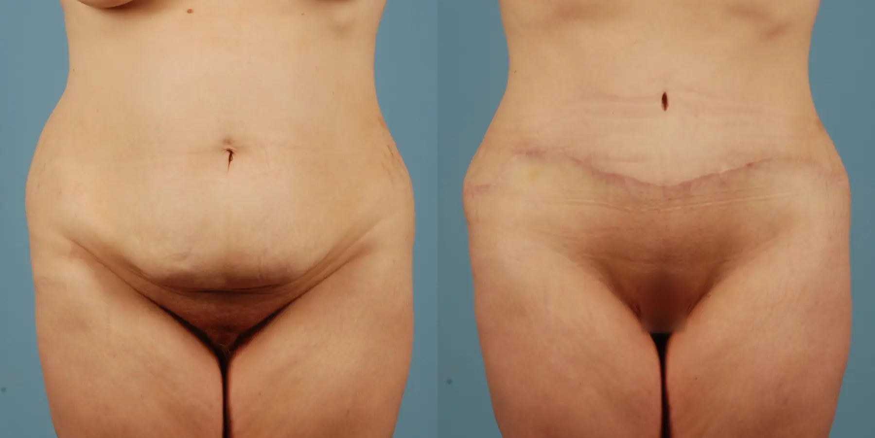 Tummy Tuck: Patient 26 - Before and After 1