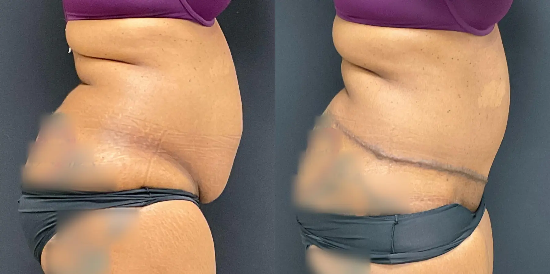 Tummy Tuck: Patient 20 - Before and After 5