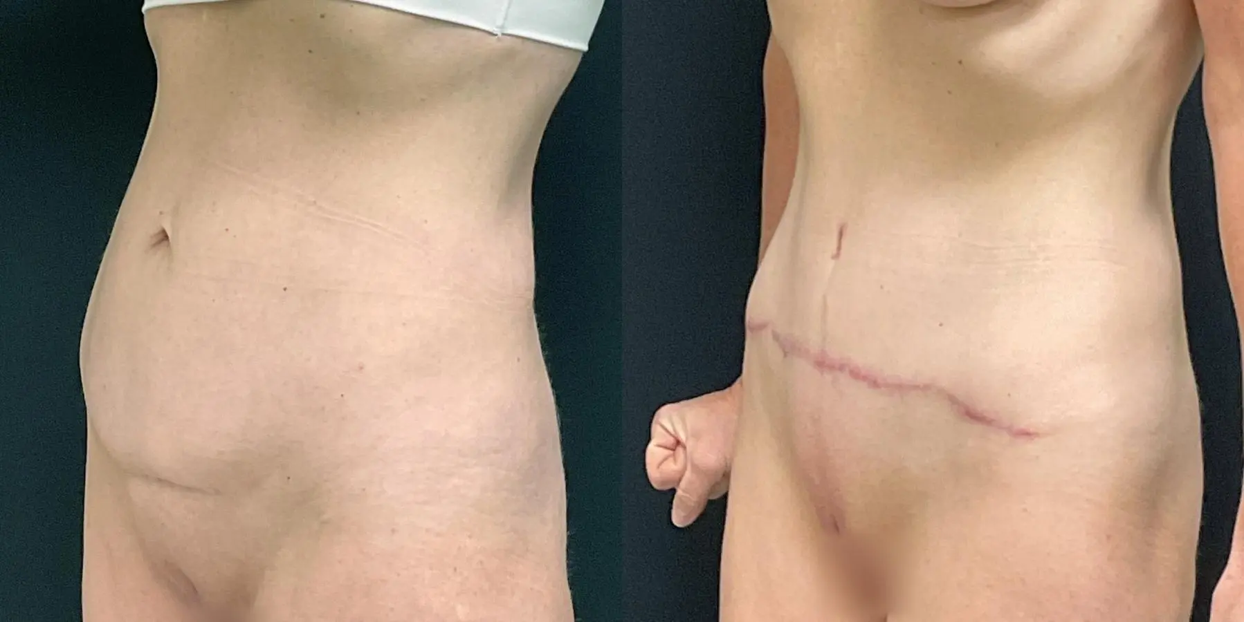 Tummy Tuck: Patient 28 - Before and After 2