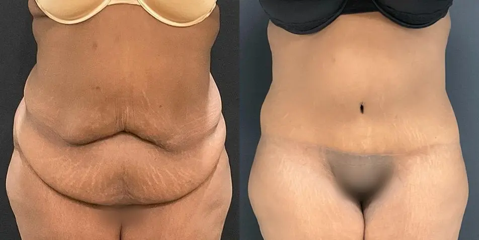 Tummy Tuck: Patient 18 - Before and After 1