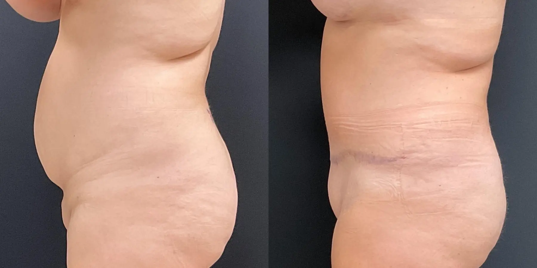 Tummy Tuck: Patient 22 - Before and After 4
