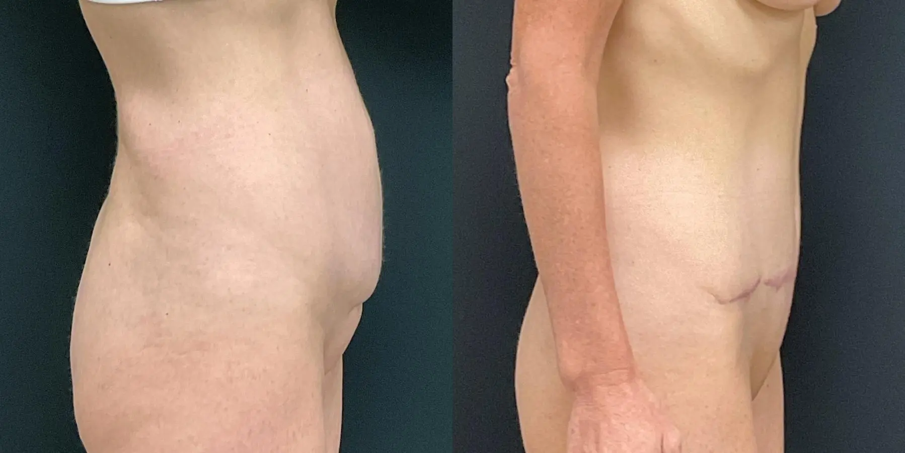 Tummy Tuck: Patient 28 - Before and After 5