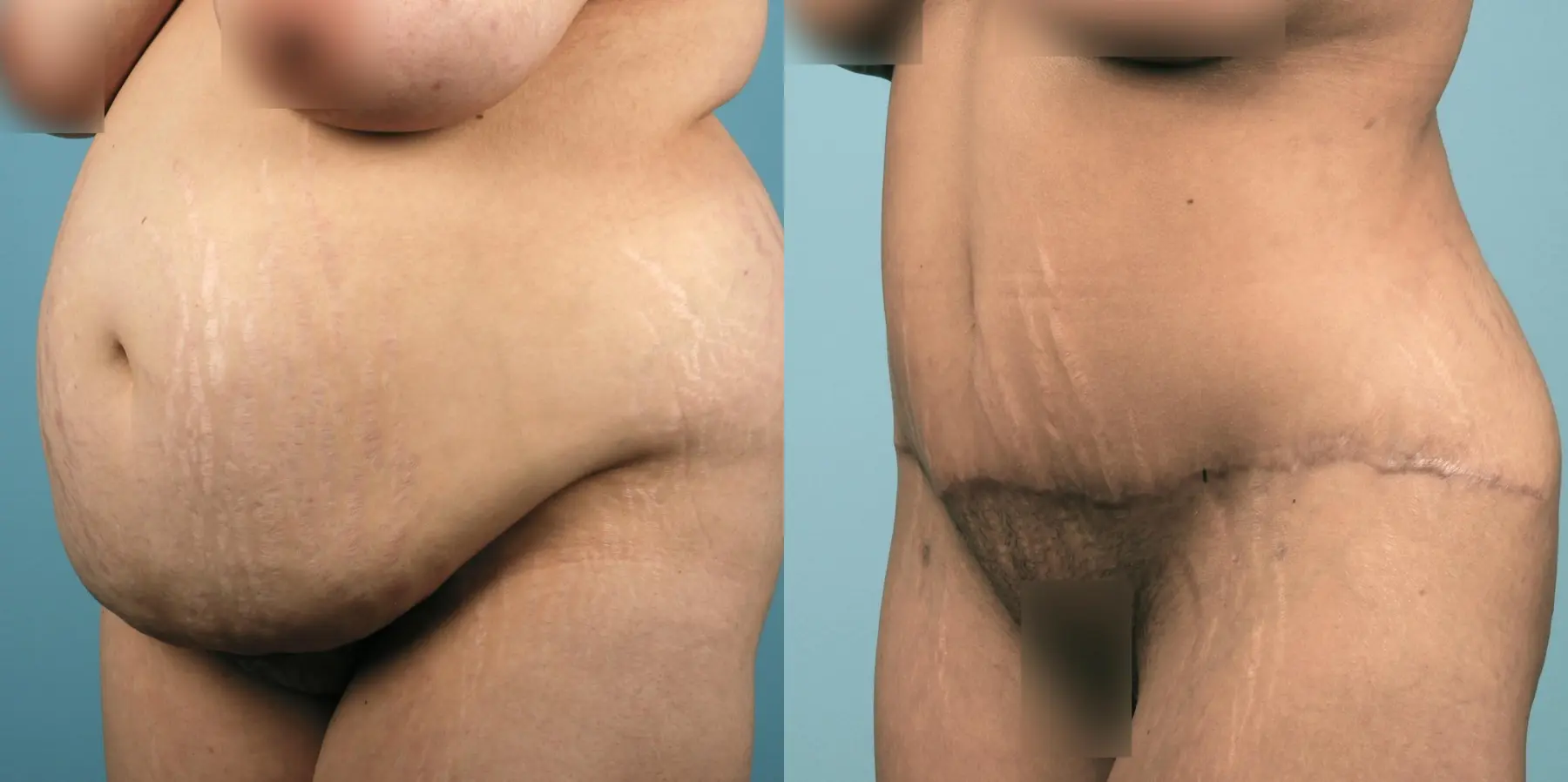 Tummy Tuck: Patient 10 - Before and After 2