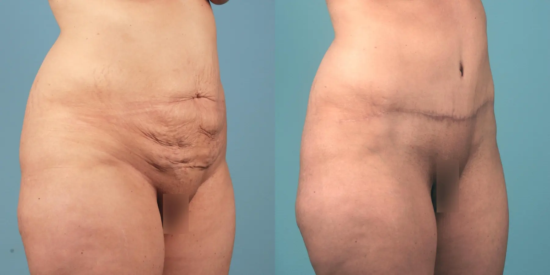 Tummy Tuck: Patient 11 - Before and After 2