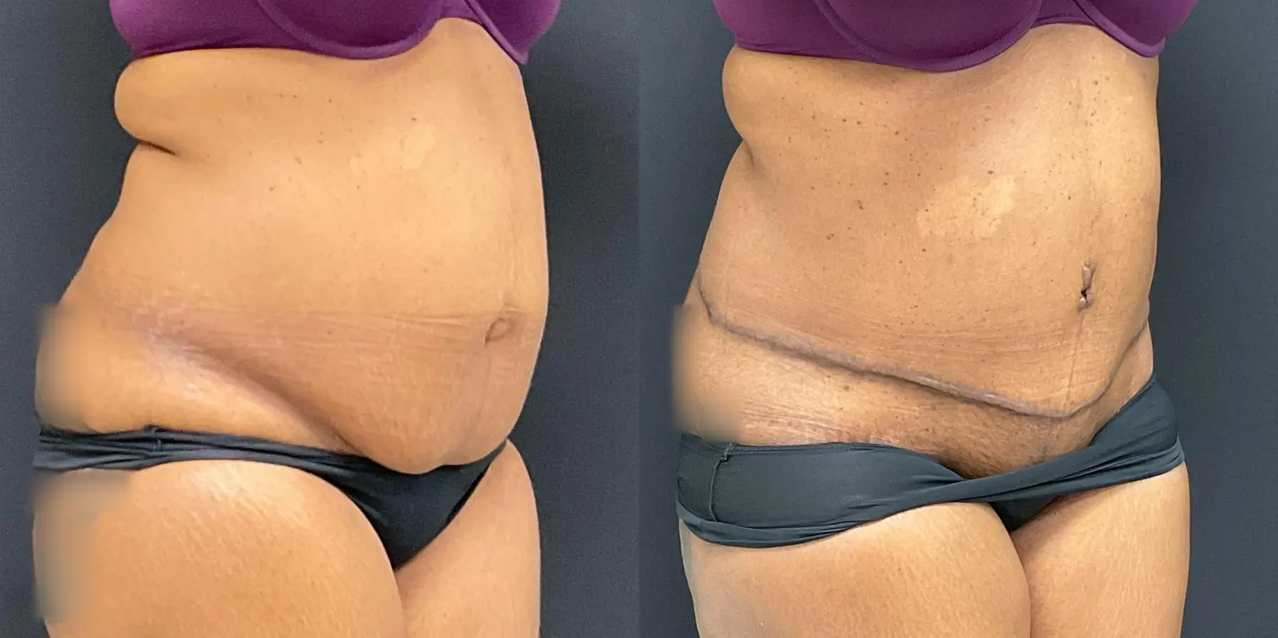 Tummy Tuck: Patient 20 - Before and After 4