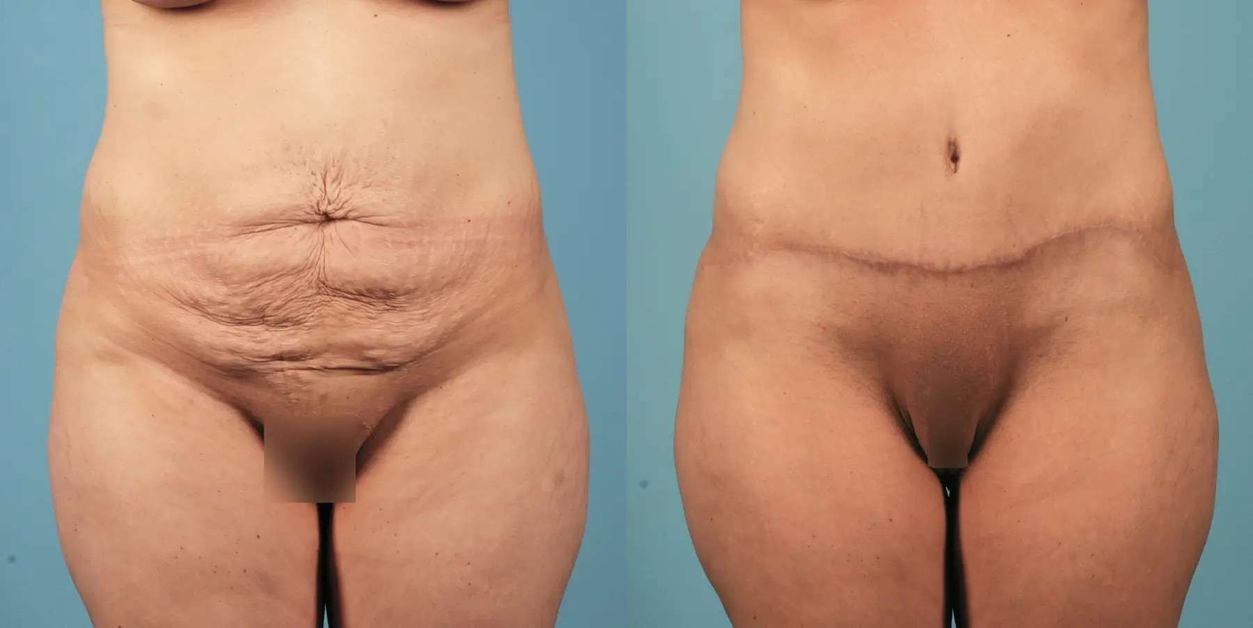 Tummy Tuck: Patient 11 - Before and After 1