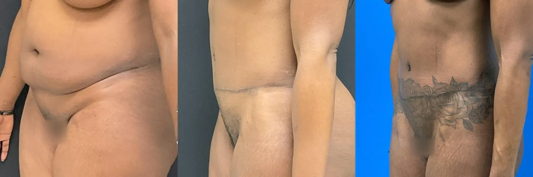Tummy Tuck: Patient 25 - Before and After 2