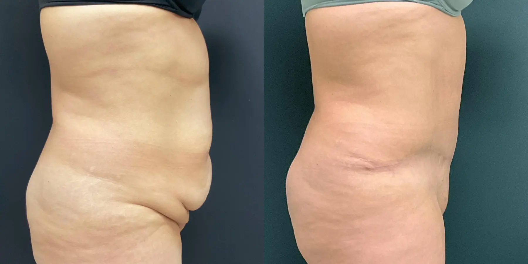 Tummy Tuck: Patient 27 - Before and After 5