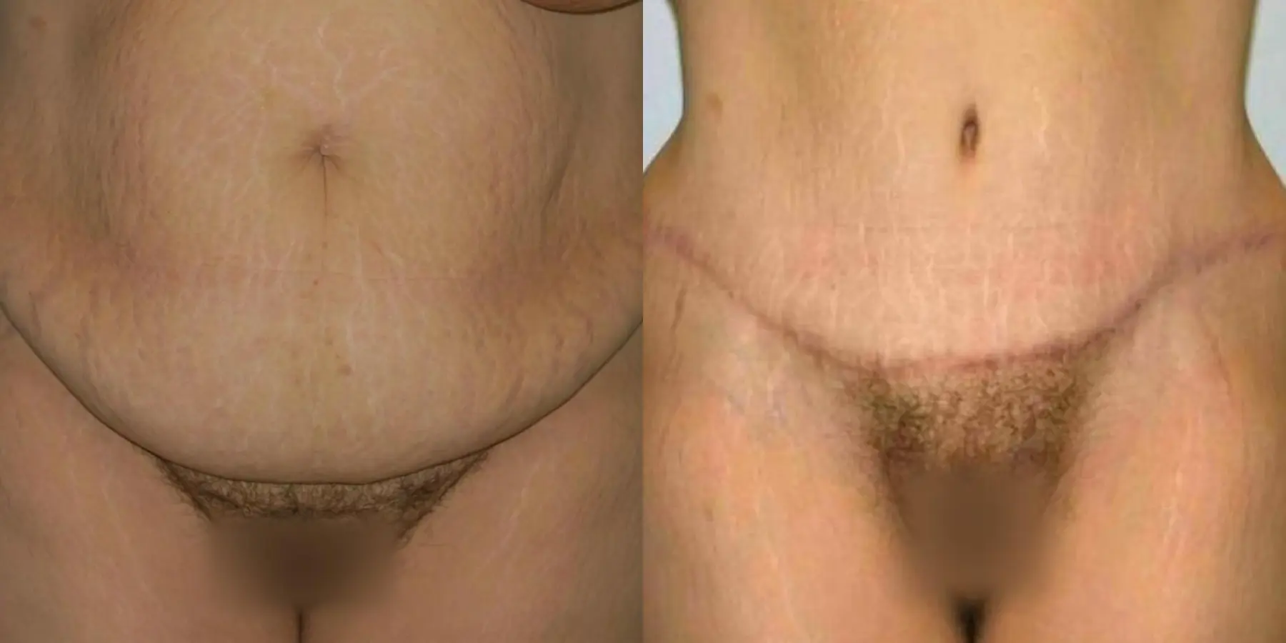 Tummy Tuck: Patient 30 - Before and After 1