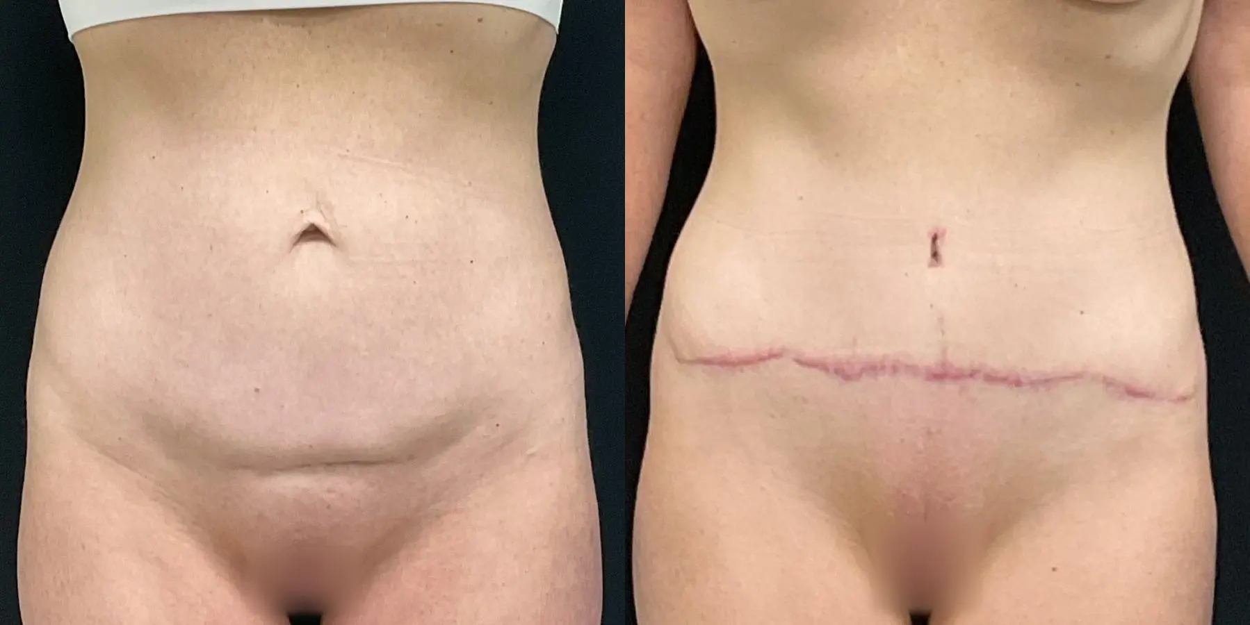 Tummy Tuck: Patient 28 - Before and After 1
