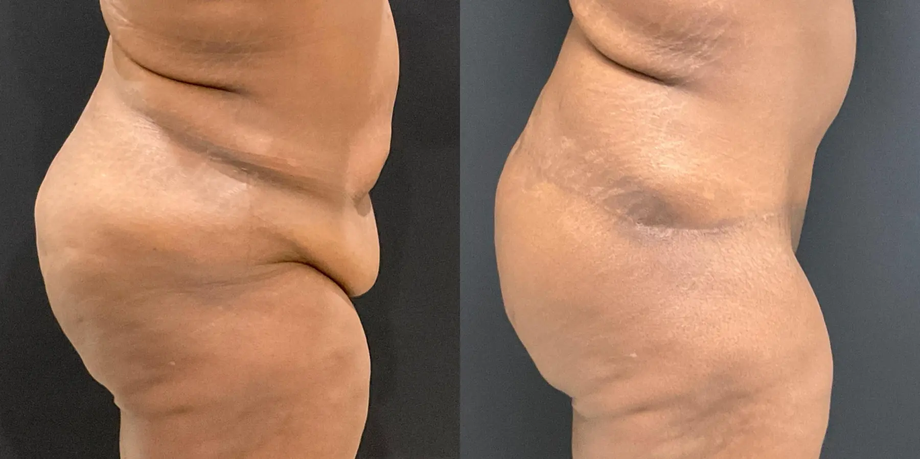 Tummy Tuck: Patient 18 - Before and After 4