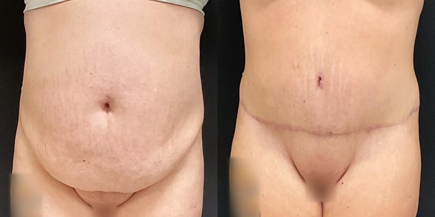 Tummy Tuck: Patient 29 - Before and After 1