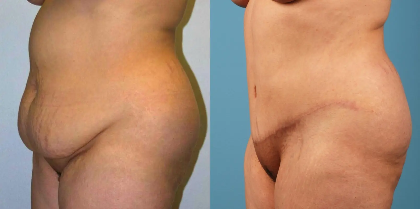 Tummy Tuck: Patient 13 - Before and After 2