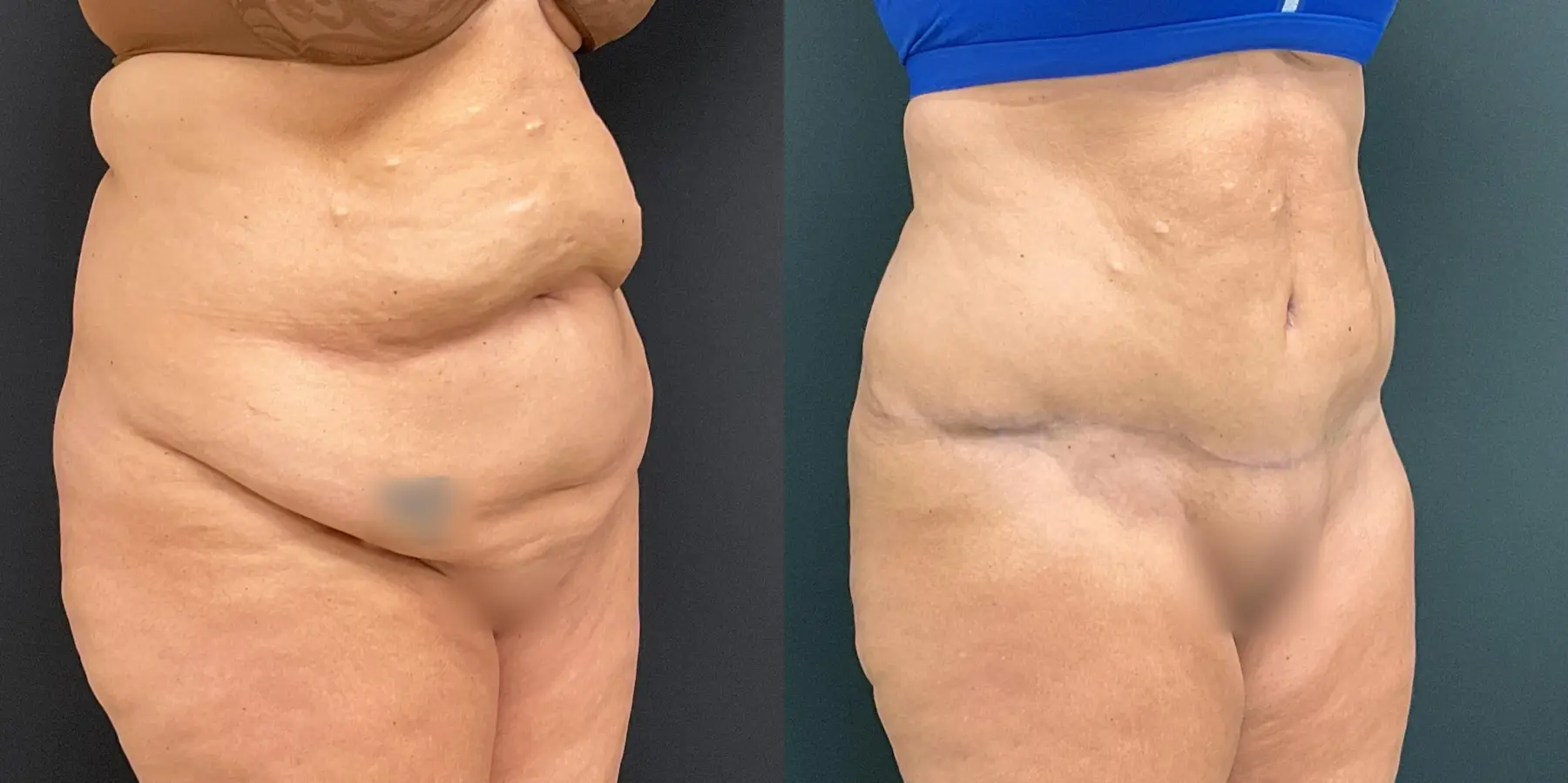 Tummy Tuck: Patient 23 - Before and After 3