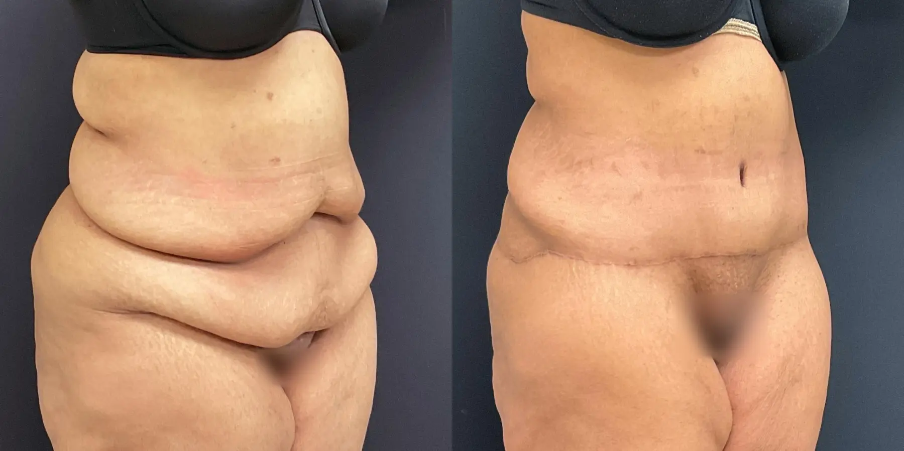 Tummy Tuck: Patient 16 - Before and After 3