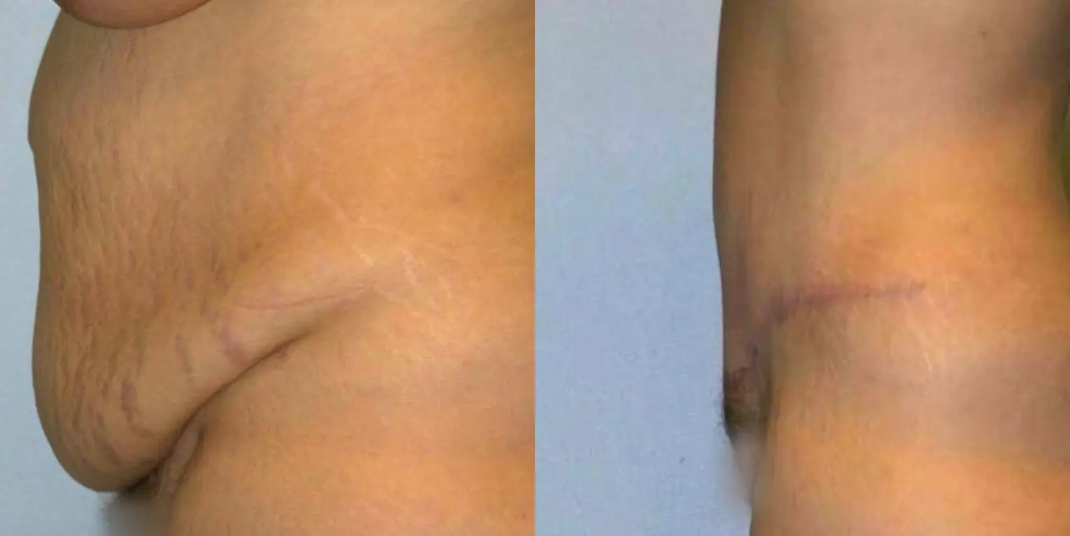 Tummy Tuck: Patient 30 - Before and After 2
