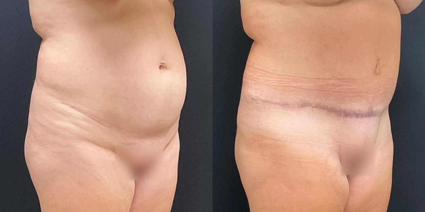 Tummy Tuck: Patient 22 - Before and After 3