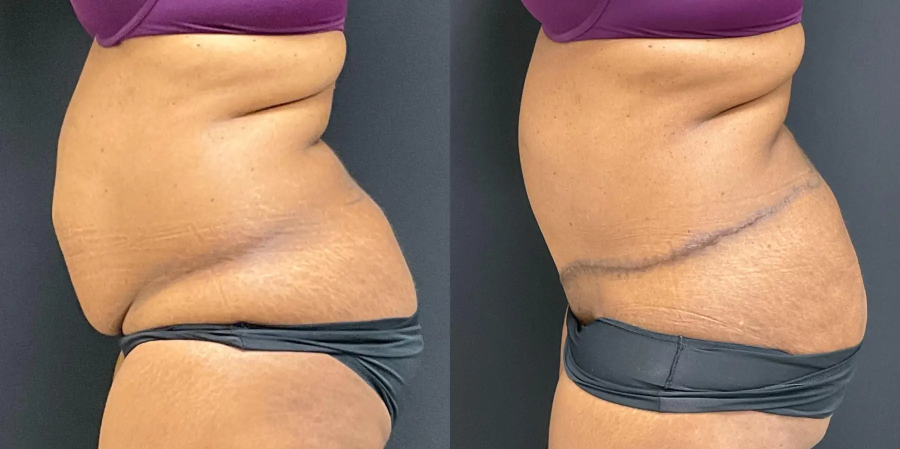 Tummy Tuck: Patient 20 - Before and After 3