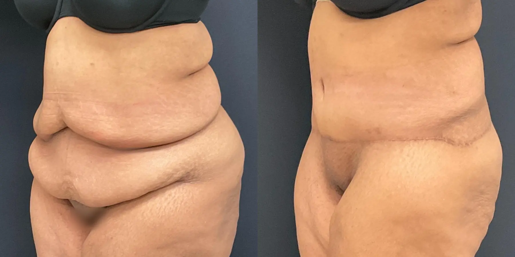 Tummy Tuck: Patient 16 - Before and After 2