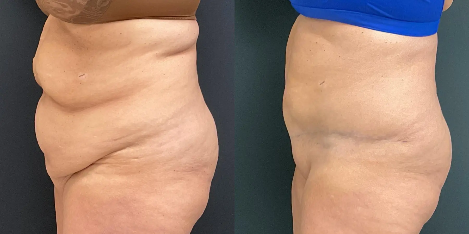 Tummy Tuck: Patient 23 - Before and After 4