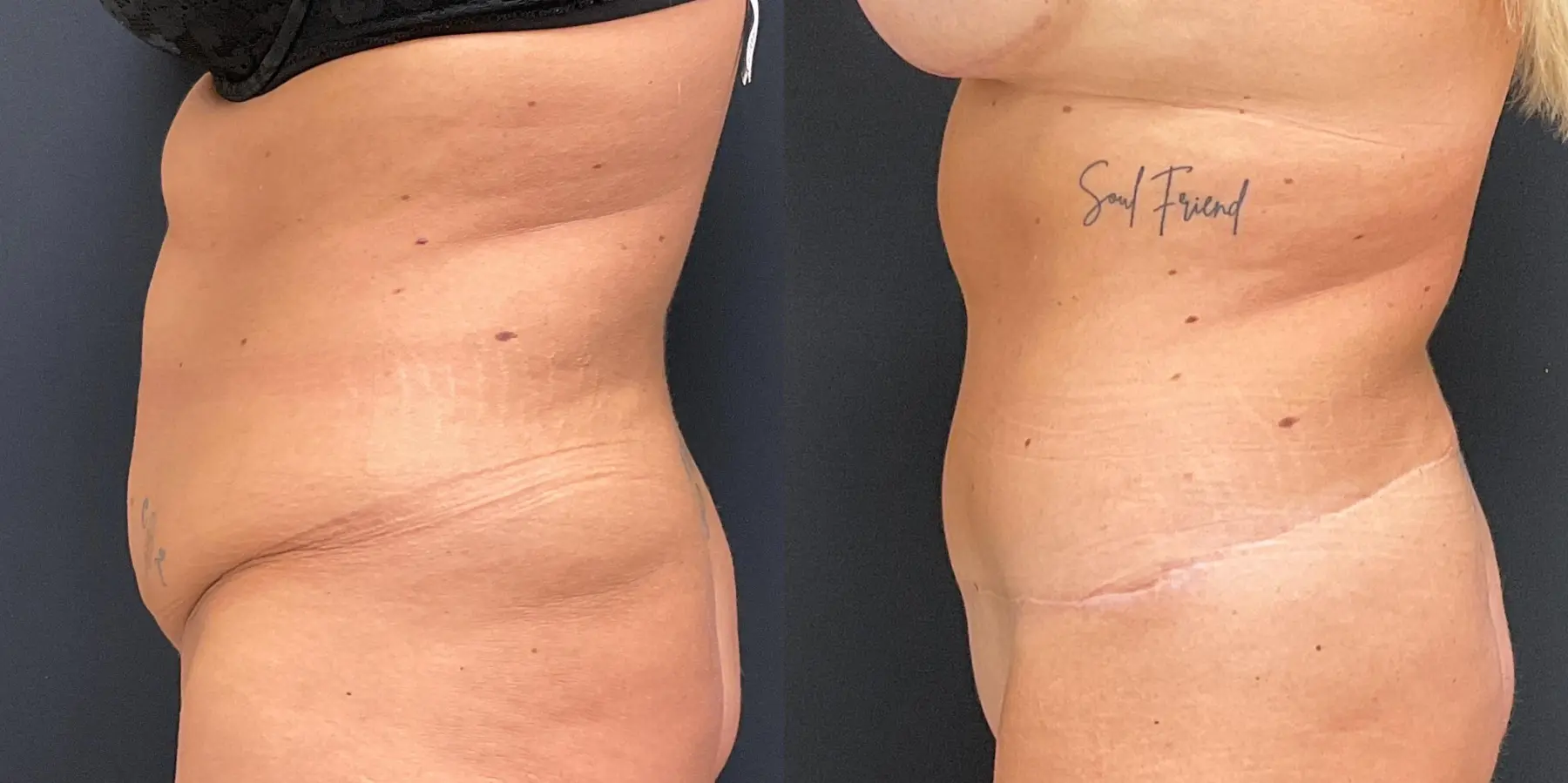 Tummy Tuck: Patient 19 - Before and After 4