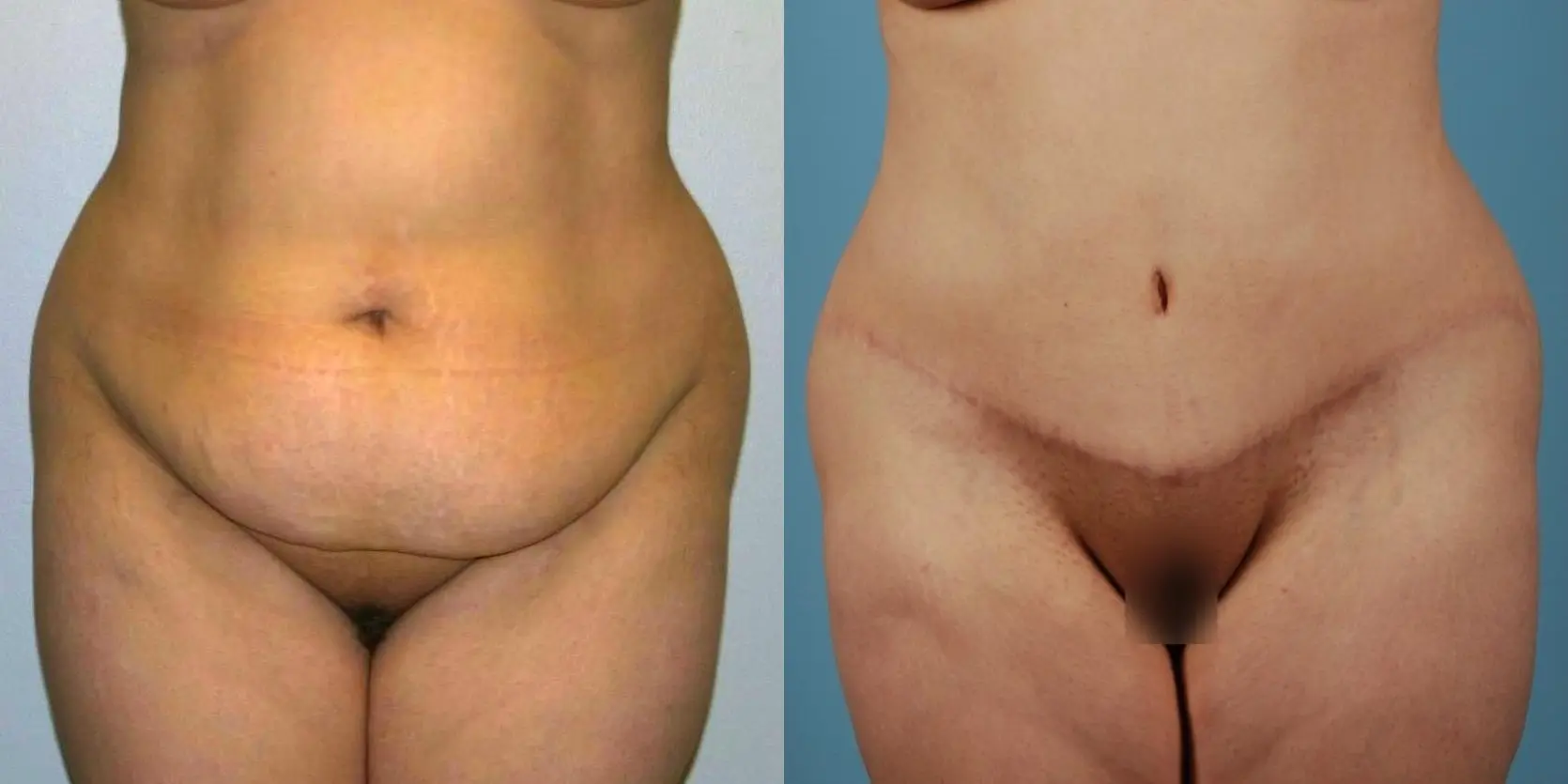 Tummy Tuck: Patient 13 - Before and After 1