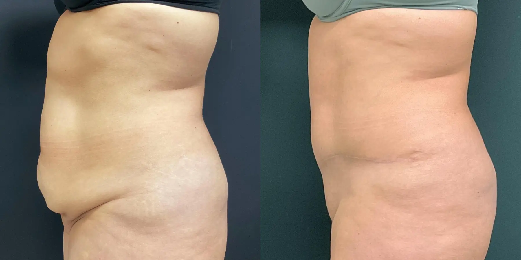 Tummy Tuck: Patient 27 - Before and After 4