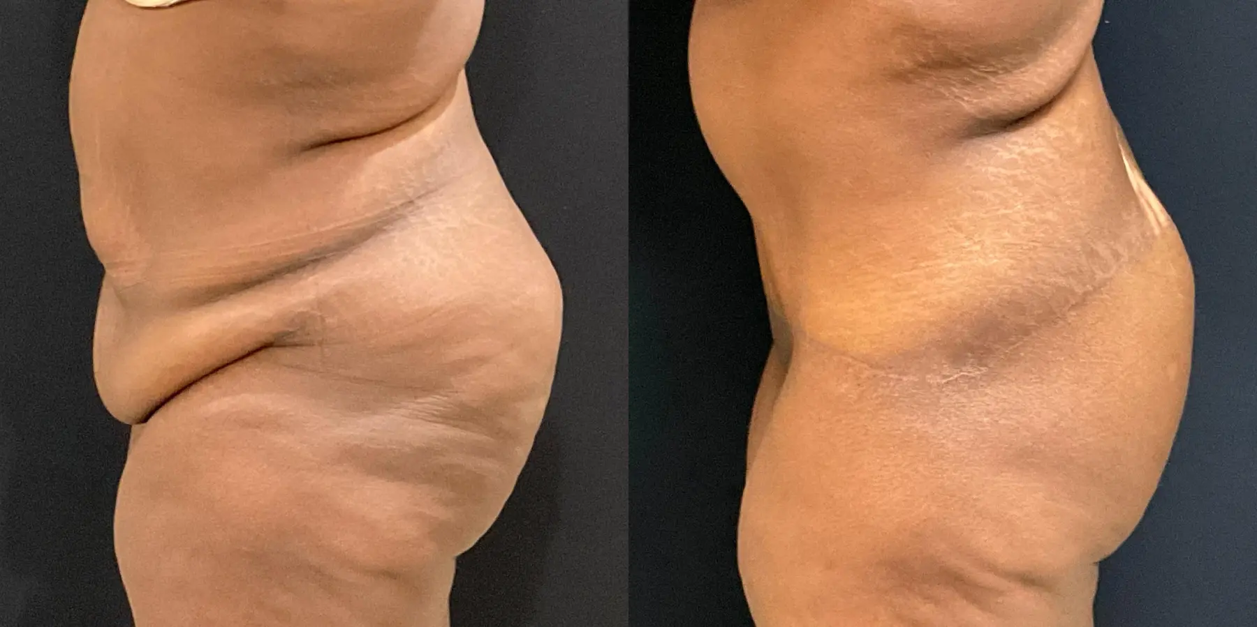 Tummy Tuck: Patient 18 - Before and After 5
