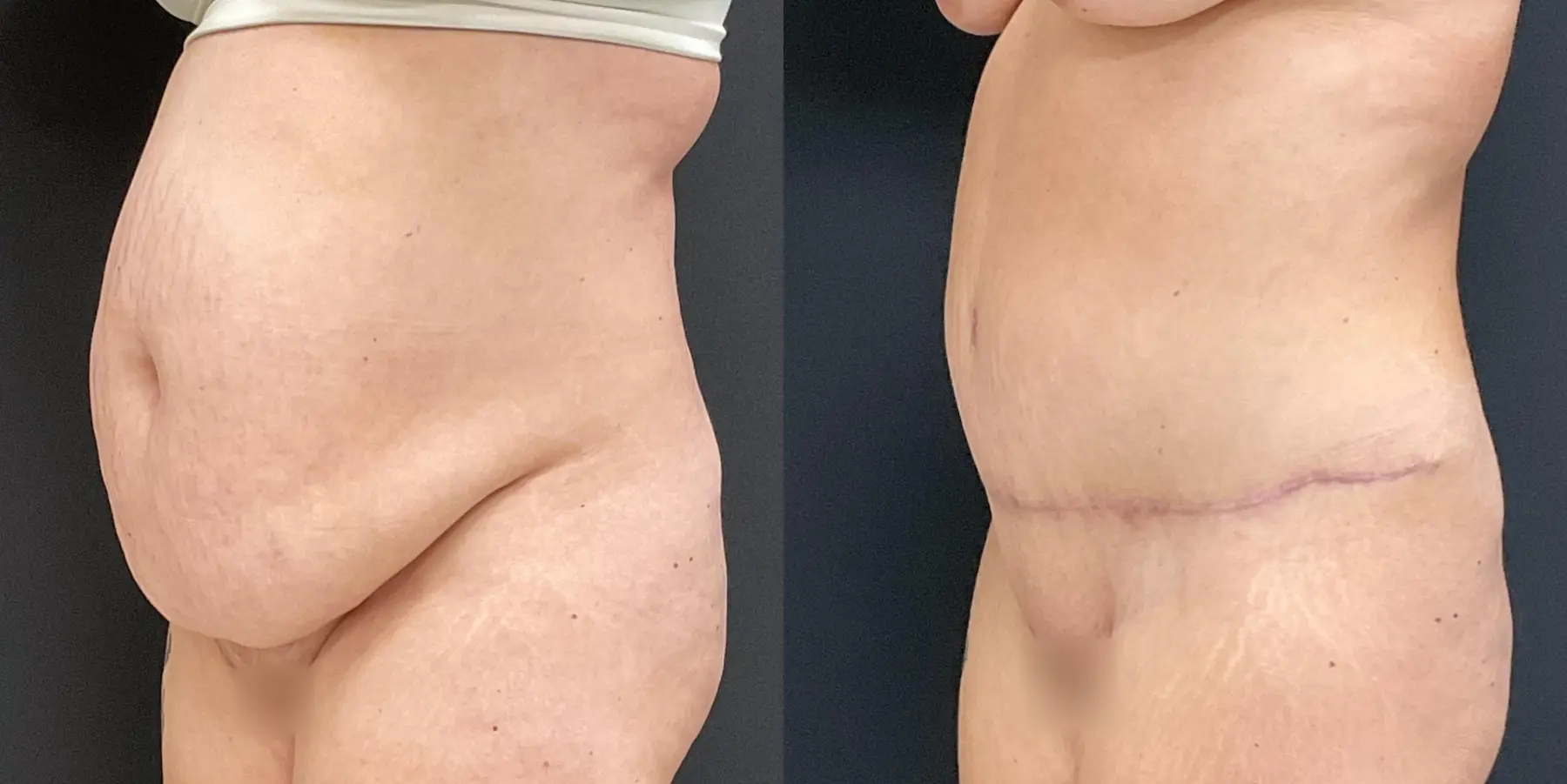 Tummy Tuck: Patient 29 - Before and After 2