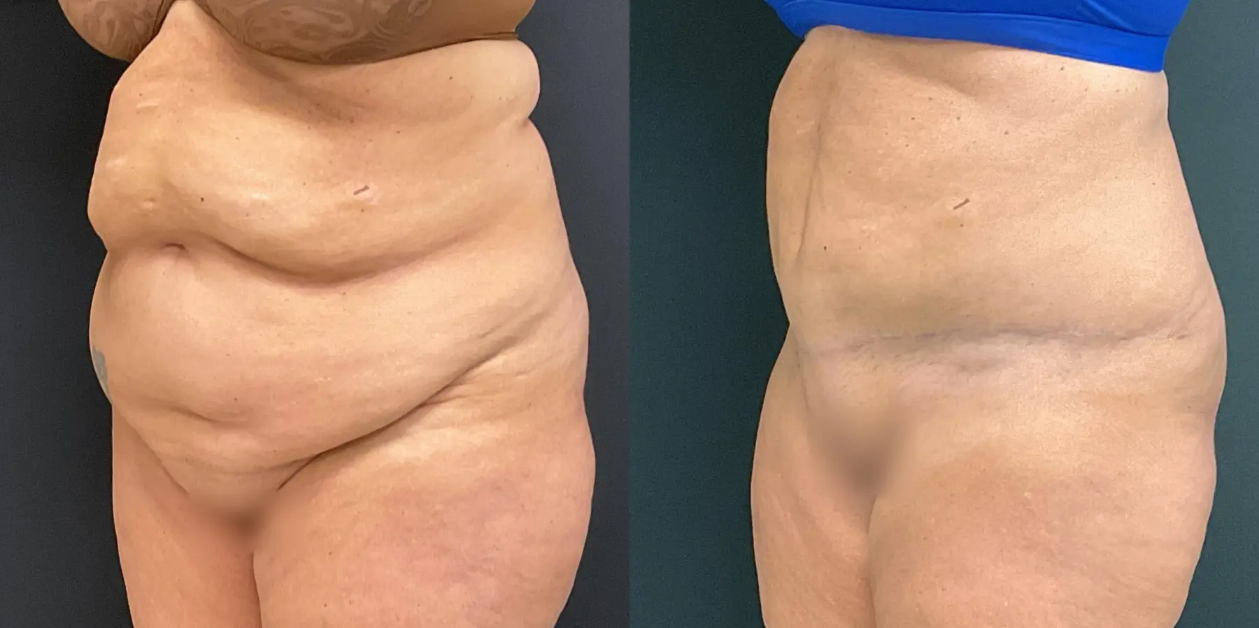 Tummy Tuck: Patient 23 - Before and After 2