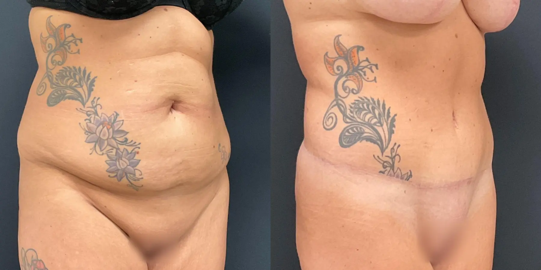 Tummy Tuck: Patient 19 - Before and After 3