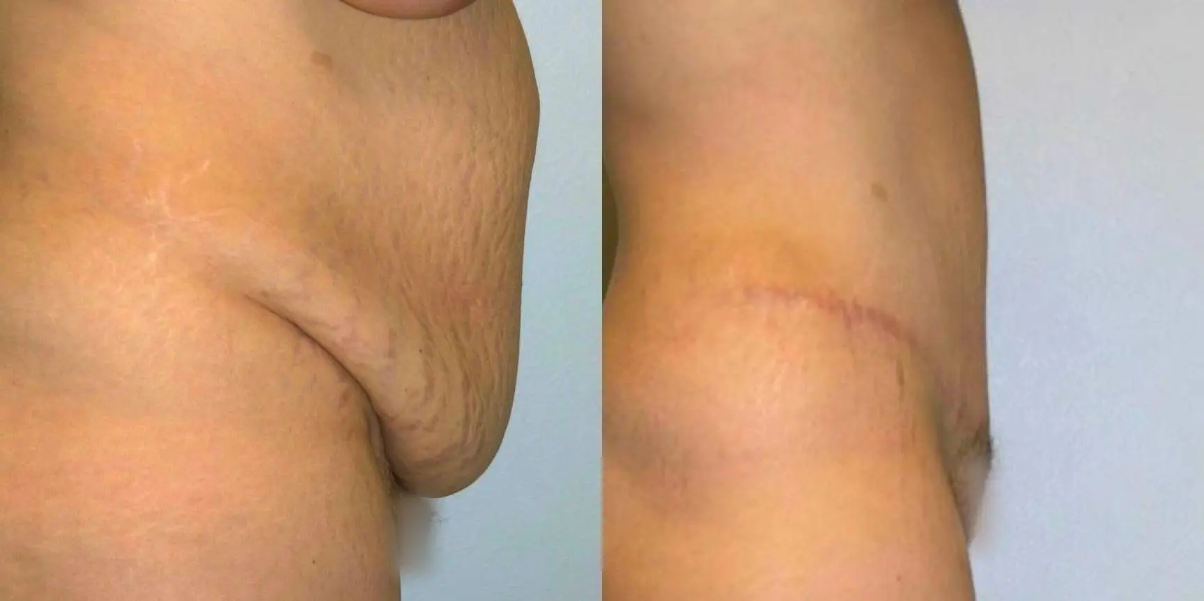 Tummy Tuck: Patient 30 - Before and After 3