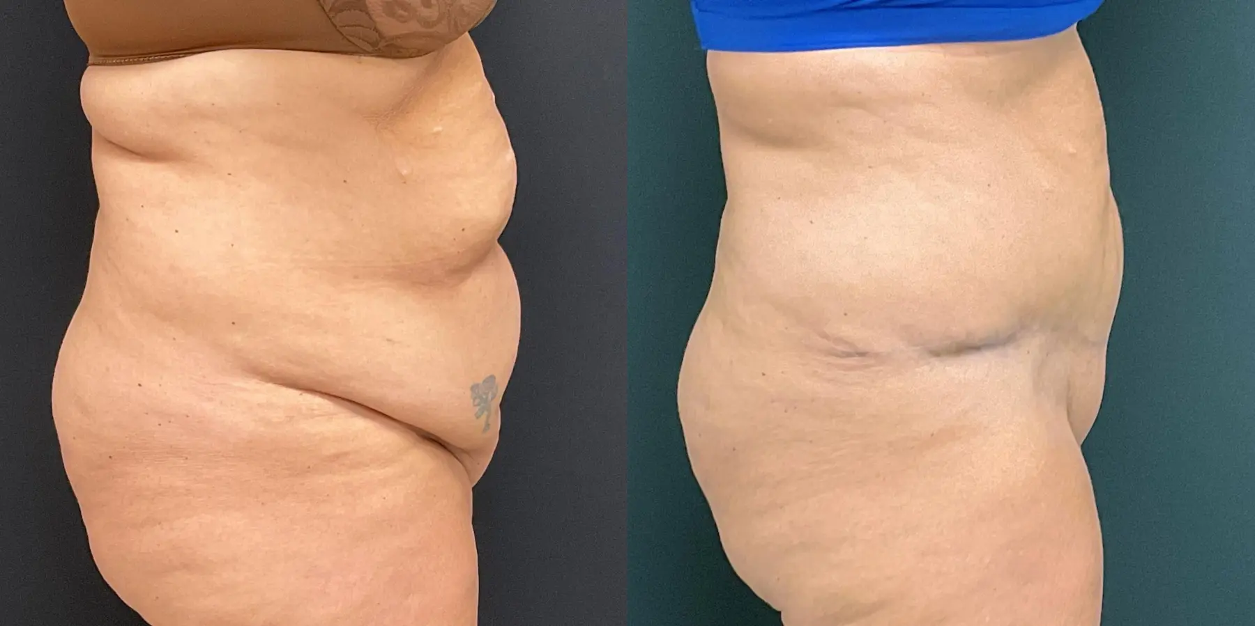 Tummy Tuck: Patient 23 - Before and After 5