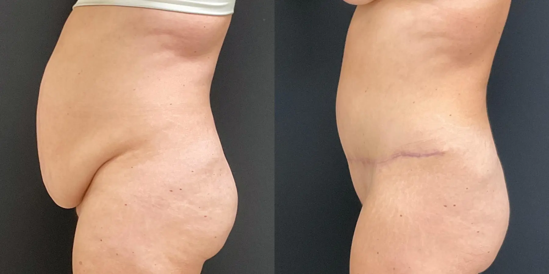 Tummy Tuck: Patient 29 - Before and After 4