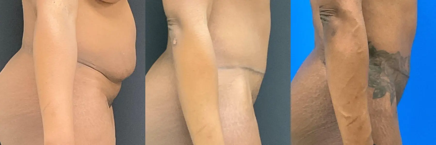 Tummy Tuck: Patient 25 - Before and After 5